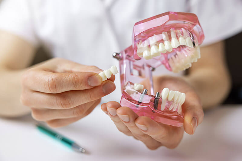 MemmingDent - Implantologie - Zahnarzt zeigt Implantate mit Gebiss